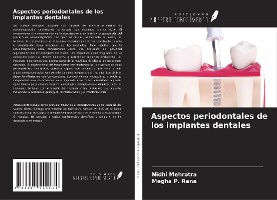 Aspectos periodontales de los implantes dentales