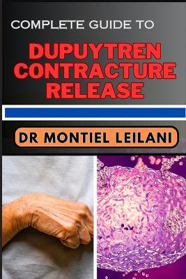 Complete Guide to Dupuytren Contracture Release