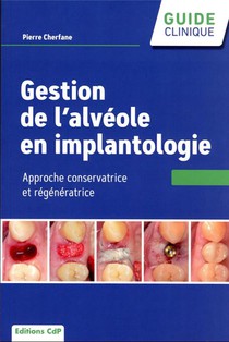 Gestion De L'alveole En Implantologie 