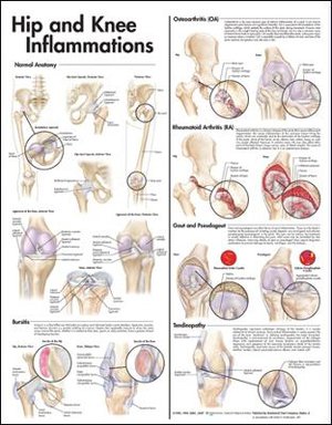 Hip and Knee Inflammations Anatomical Chart 
