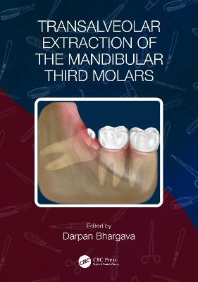 Transalveolar Extraction Of The Mandibular Third Molars