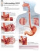 Understanding GERD (Gastroesophageal Reflux Disease) Paper Poster