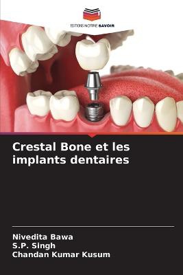 Crestal Bone et les implants dentaires